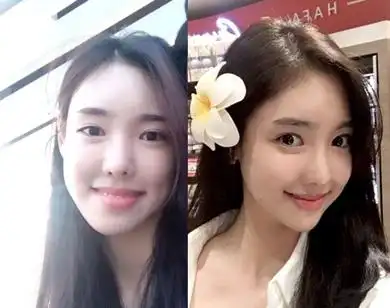 长脸变短有自然方法吗韩国下巴缩短手术图解分享