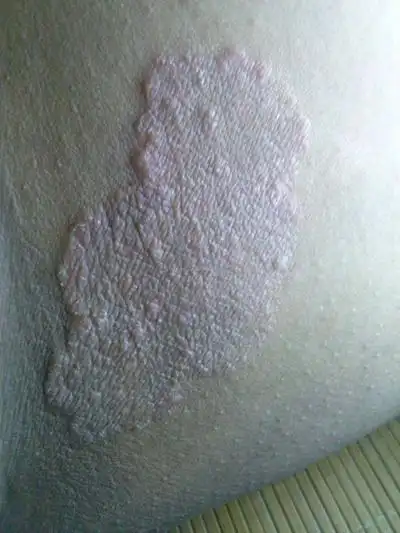 股癣初期图片 (48)