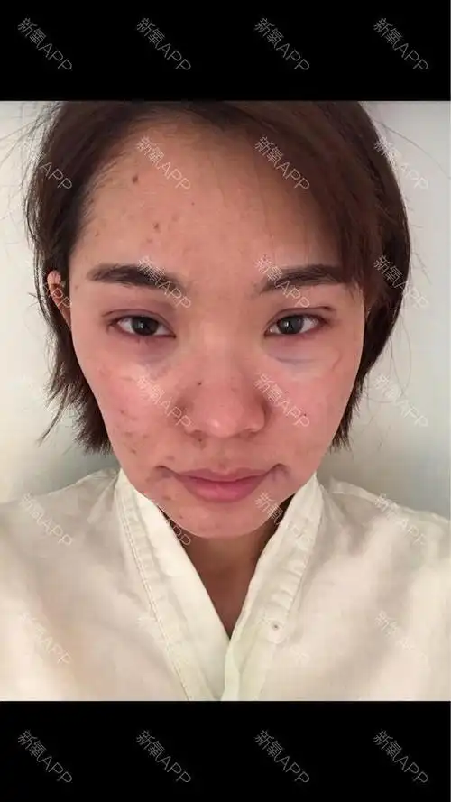 自体脂肪面部填充