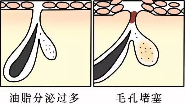 昆明毛孔粗大的改善方法有哪些?【昆明华美美莱】