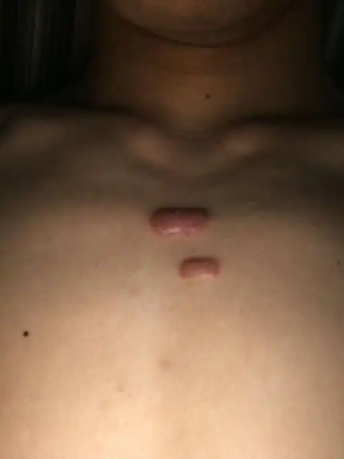 胸前长了个粉刺挤完之后就长出这种大豆,好几年了.能切掉么?