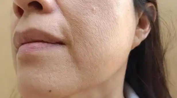 皮肤屏障是我们皮肤的保护层,就是皮