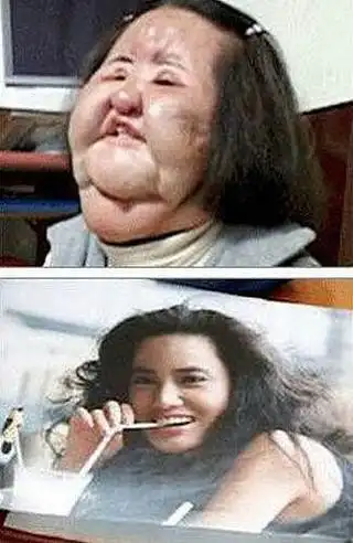 女明星整容失败 惨不忍睹的恐怖后遗症