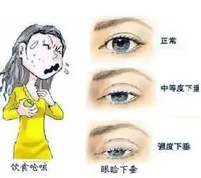 揭秘重症肌无力疾病症状有几种类型?