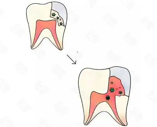 上饶补牙齿哪家医院好?补牙便宜又好的牙科在这里! - 贝色口腔