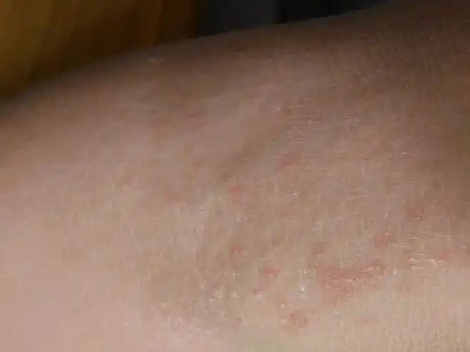 这是湿疹还是热痱子,手脚折叠处有,有时会痒.怎样处理好?