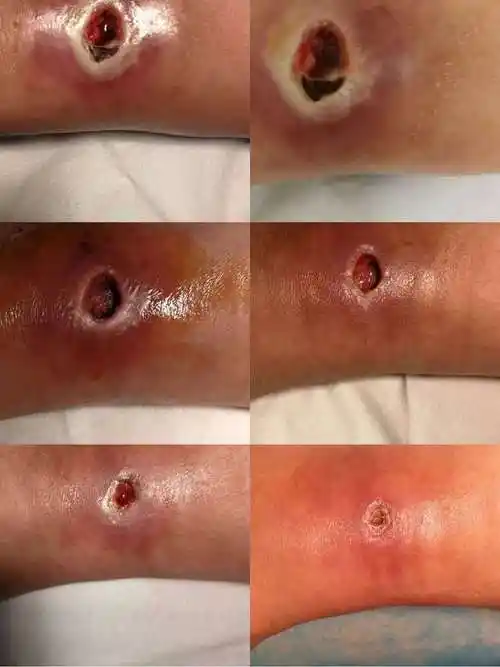 贴个网红创可贴扬州男子小伤口烂成了无底洞