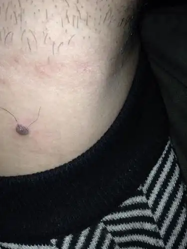 脖子上长了十几年的肉痣昨天疼起来了今天感觉就痣周围就红肿了两张