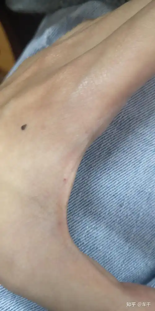 虎口上有痣的人会怎么样? - 知乎