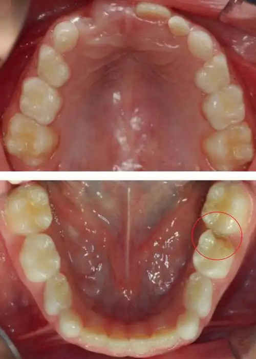(上颌和下颌弓的正面临床视图)口腔内检查发现左侧第二乳磨牙有龋齿