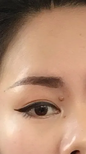 眼下这颗痣可以除掉吗?