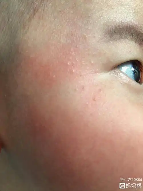 善良!湿疹与热疹的区别图片"哪个靠谱"-第1张图片-庞杂网