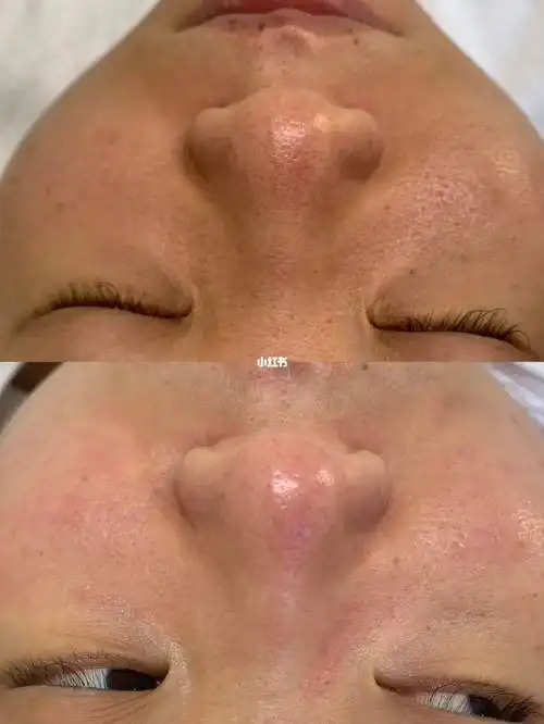 毛孔深层清洁一次前后对比90_深层清洁_毛孔_收缩毛孔_清洁毛孔