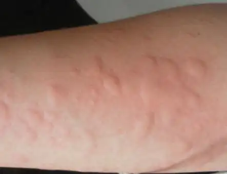 划痕性荨麻疹有哪些症状荨麻疹如何检查出来