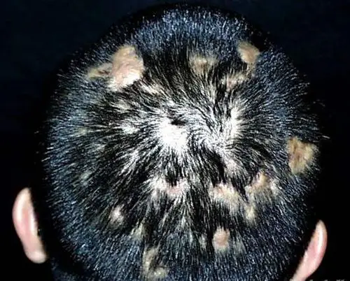 皮肤病的种类图片大全红斑图片