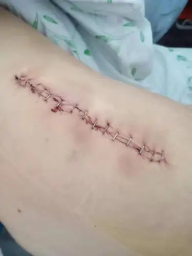 据说对皮肤伤害最小.比一般缝合贵.