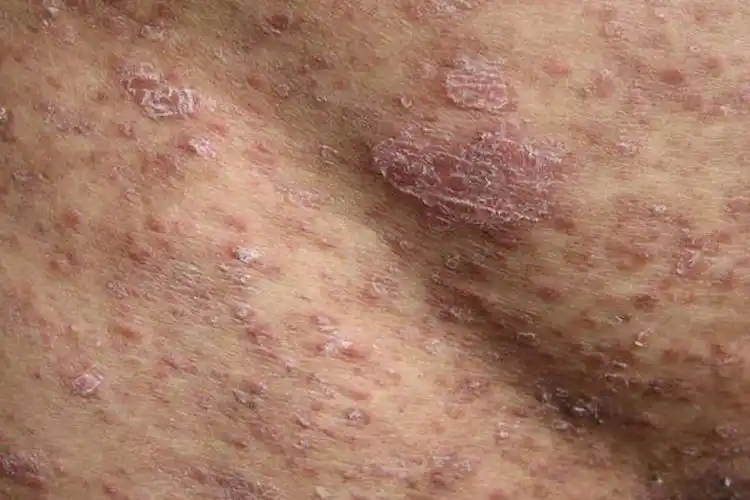 点滴型银屑病图片