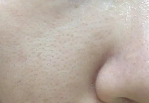 简单三招,拯救你的毛孔粗大,让你毛孔细到看不出_皮肤