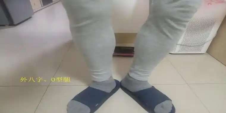 外八字步怎么矫正外八字的纠正性训练