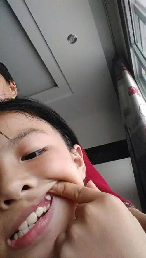 小孩有一颗牙齿长到牙龈壁上了怎么办?在右上方多出了一颗!