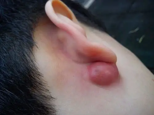 耳朵后边的皮脂腺囊肿图片