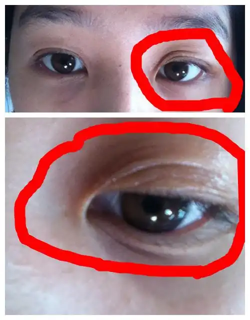 我的左眼皮突然多了一小层!很难看!不对称的眼睛!求帮助!