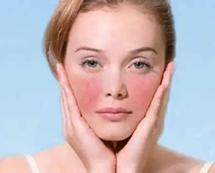 今天小编就分享一些关于红血丝肌肤的护理知识,希望对敏感肌有所帮助