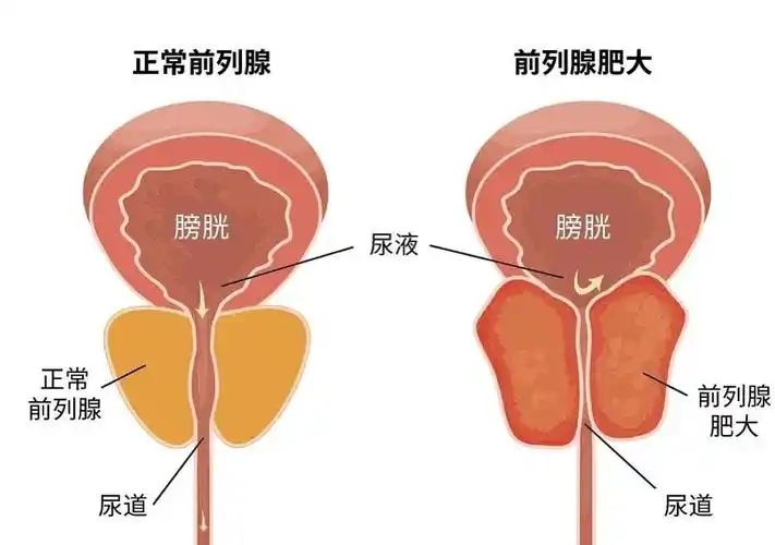急性男性前列腺炎患者康复密码