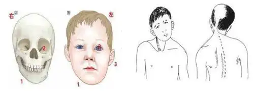 科普一下!宝宝爱歪头,家长要当心,原来是因为这个