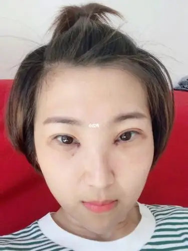 失败案例_双眼皮_眼睑下至_内双_内眼角_双眼皮手术_美妆_医美整形