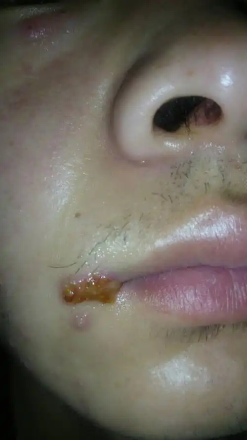 一个星期前 那两天没怎么吃饭 晚上还经常熬夜到2 3点 过两天嘴角有点