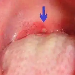 疱疹性咽峡炎进入高发期,宝宝出现这些症状家长要警惕!