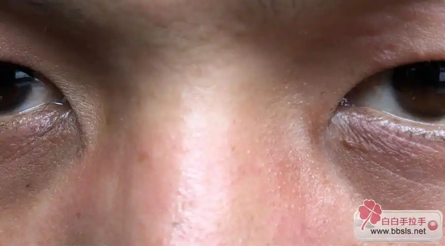 内眼角伍德灯下发白,会是白癜风吗?
