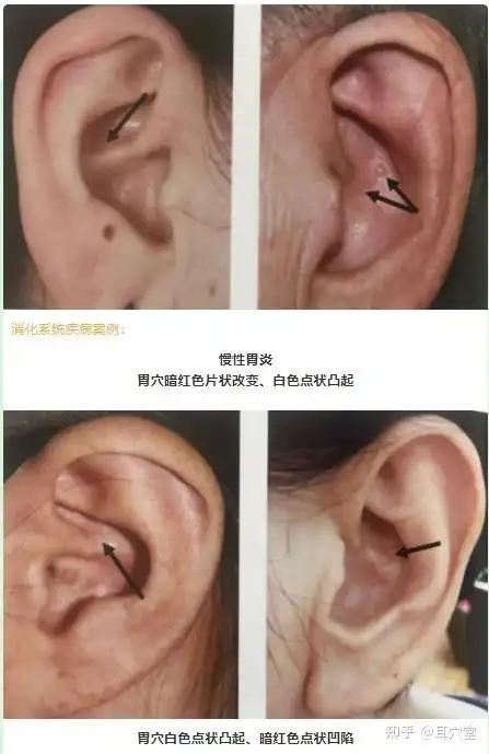 观耳诊病慢性胃炎