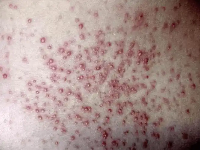 前胸后背,头皮,私处反复长红疙瘩,小心是毛囊炎作祟_医生_治疗_症状