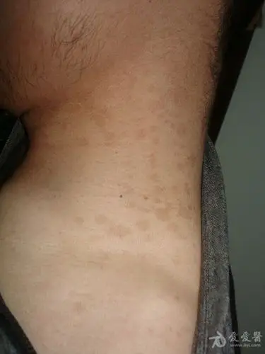 脖子边有多处斑块?不疼也不痒