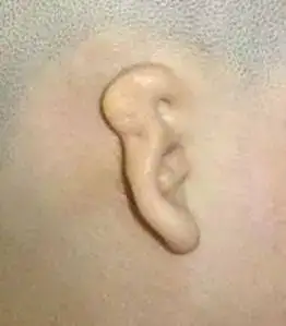 第二级:无耳廓正常形态,仅有腊肠样或条索样隆起,可触及软骨,但无结构