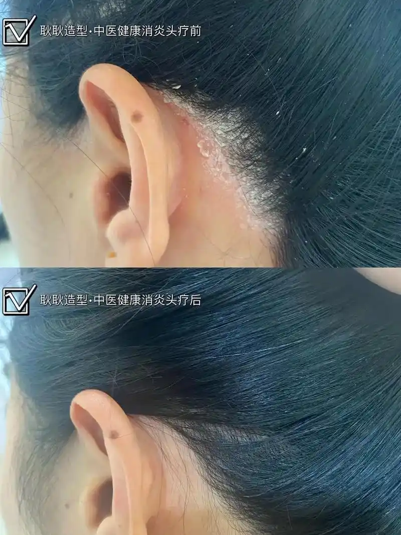 头皮炎症#脂溢性皮炎 - 抖音