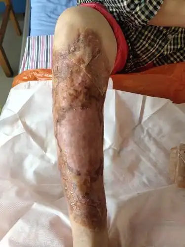 11.4陆瑞红右小腿皮肤溃疡换药录 - 美篇