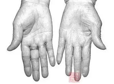 她是胃癌转移舌癌