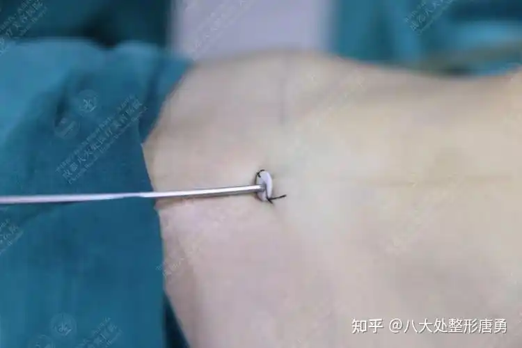 科普篇腰腹吸脂手术全过程手术前先知道