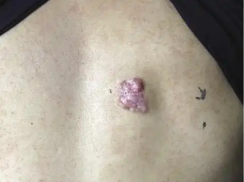 是一种生长缓慢,起源于皮肤并可扩展至皮下组织的低度恶性的纤维肉瘤