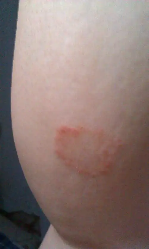 如图,有皮肤科的专家知道这是什么皮肤病吗_百度知道