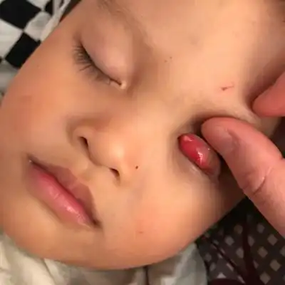 2周9孩子眼睛长了个这个,闭眼才看见一个圆圆的,睁眼就看不见,眼皮翻