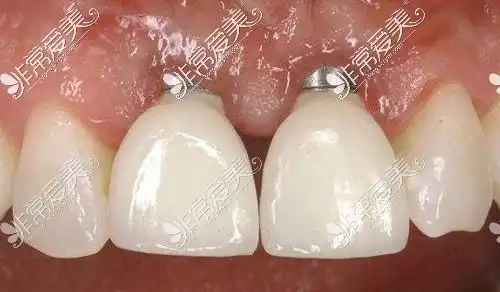 种植牙一期失败的症状我感觉我种牙失败了但医生不承认