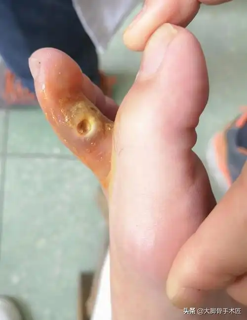 第四,锤状趾疼痛:二三四趾受到踇趾挤压后,其趾长,短屈肌紧张或挛缩