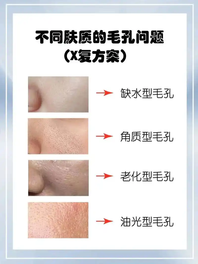 毛孔粗大怎么办71分清毛孔粗大类型正确护肤.