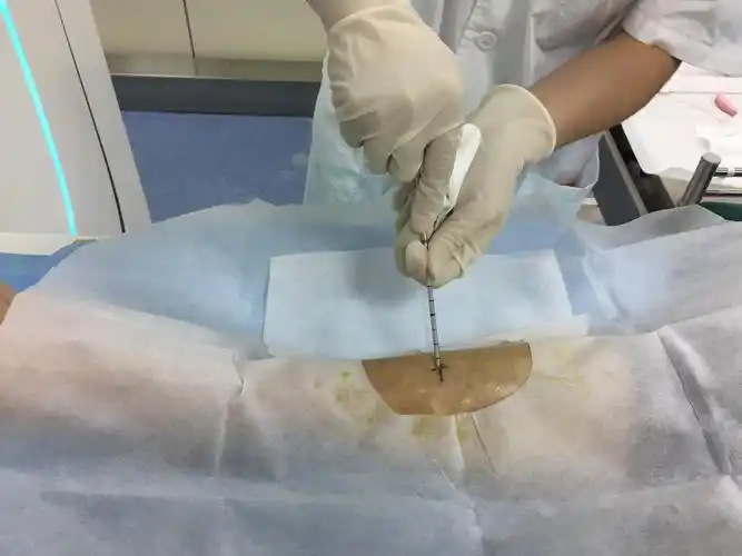 安徽省肿瘤医院门诊穿刺流程及注意事项 - 好大夫在线