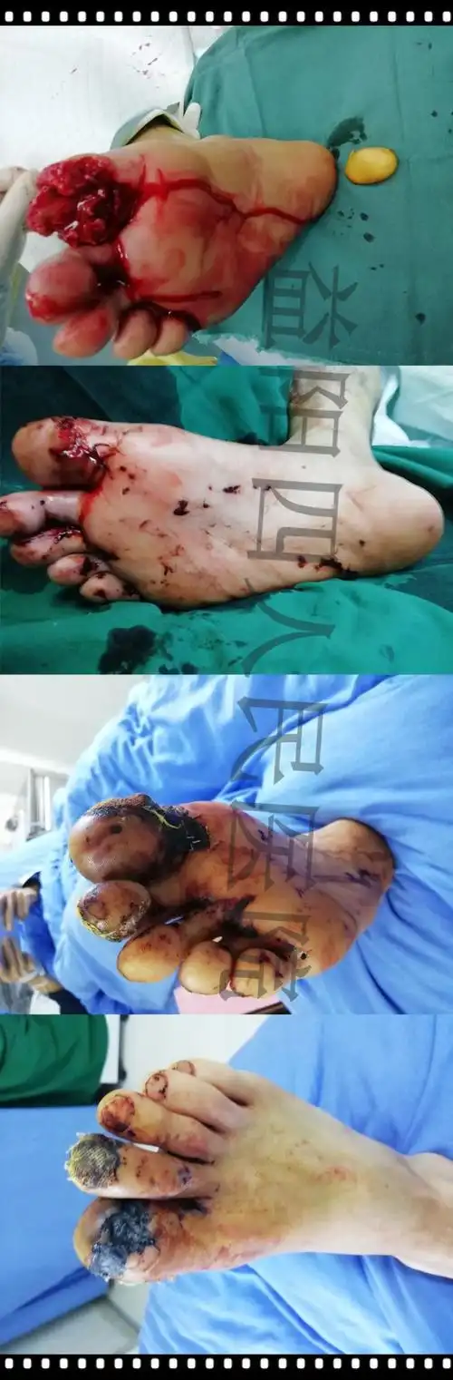 脚趾头的压砸离断伤