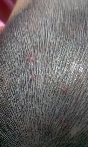 治疗毛囊炎可以用膏药吗